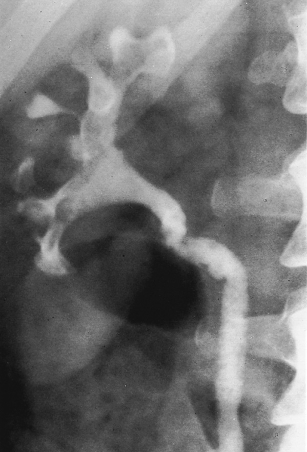 Pyeloureteritis cystica. A staghorn calculus occupies much of the collecting system. *