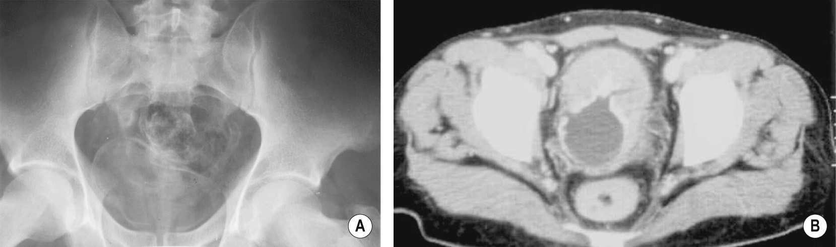 Schistosomiasis. Plain XR (A) showing linear calcification along the bladder wall and distal left ureter. CT (B) demonstrating bladder wall calcification and thickening – this may be gross and (as here) associated with rectal wall thickening. †