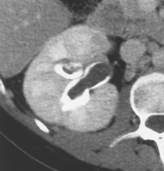 Calyceal fungus debris. CECT demonstrating radiolucent material forming a cast of the calyces. The material was fungal debris in this immunosuppressed patient. ∫