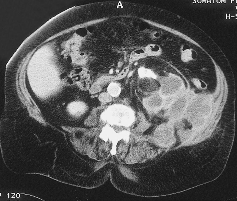 Chronic pyonephrosis. There is marked cortical loss and modest collecting system dilatation. The CT also demonstrates the pelvic calculus responsible and a multiloculated perinephric abscess, which has extended laterally into the abdominal wall and posteriorly into the psoas muscle. †