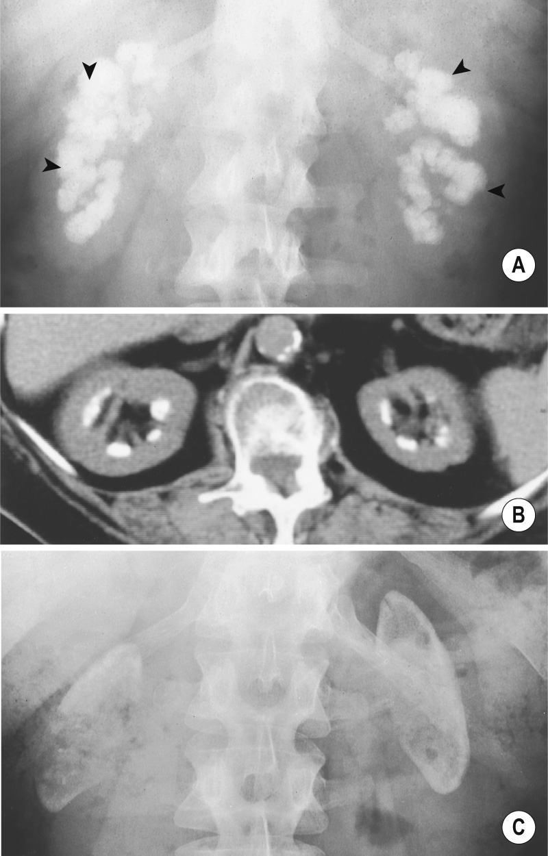 (A) Medullary nephrocalcinosis (arrowheads) with the corresponding CT appearances (B). (C) Cortical nephrocalcinosis. ∫