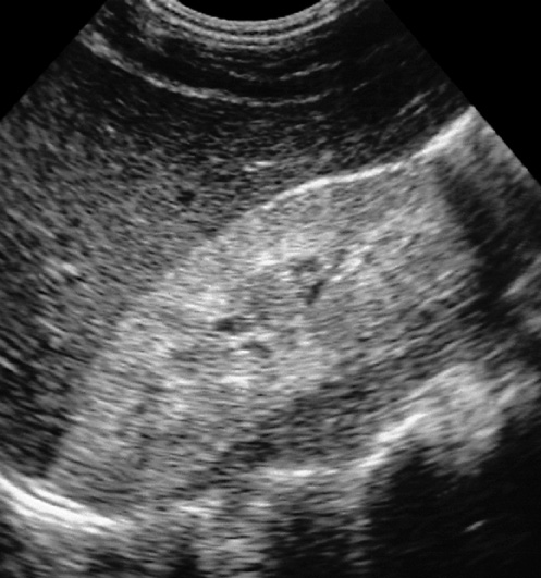 Renal parenchymal disease. Longitudinal US of the right kidney shows increased reflectivity compared to the adjacent liver. *