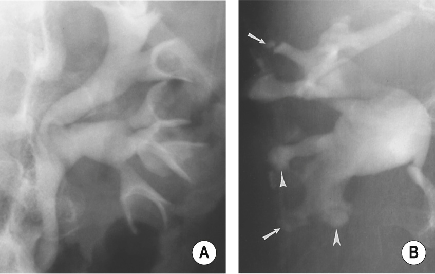 Papillary necrosis. (A) Lobster claw deformity. (B) Focal papillary contrast collections (arrows) associated with abnormal calyces (arrowheads). ∫
