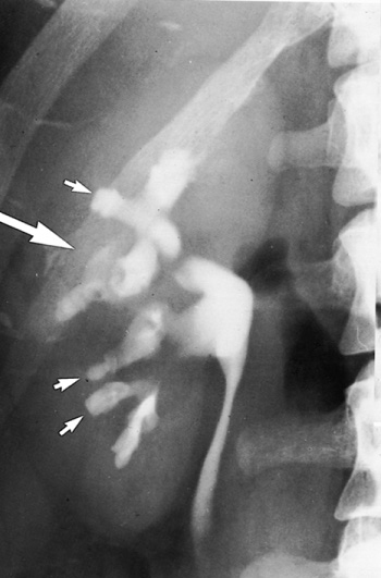 Analgesic nephropathy. Characteristic ‘egg in cup’ cavities (short arrows) and a ‘horn’ (long arrow). *