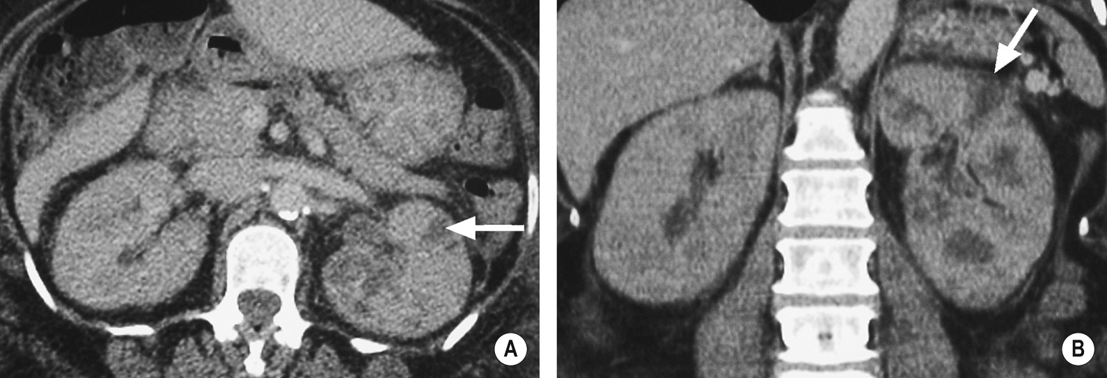 Diffuse unilateral acute pyelonephritis. (A) Axial and (B) coronal enhanced CT shows wedge- and band-shaped areas of reduced enhancement in the left kidney (arrow). There is associated perinephric inflammatory change. *