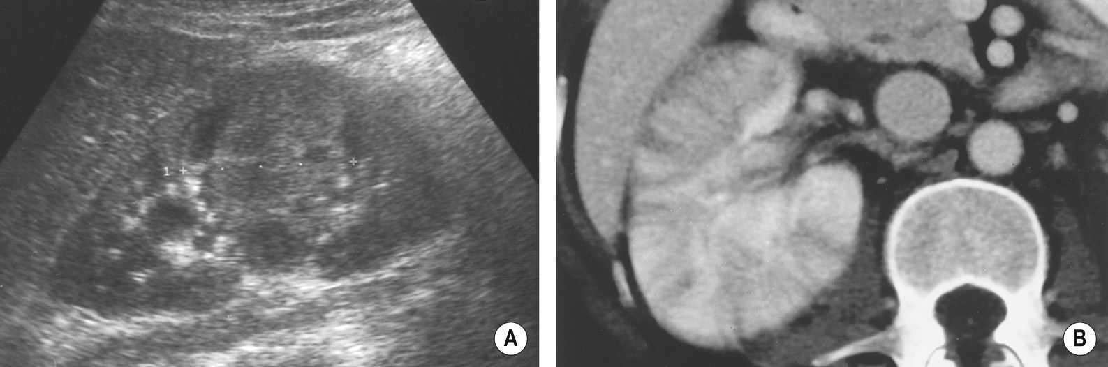 (A) Focal severe pyelonephritis appearing on US as a slightly heterogeneous mass. † (B) Acute pyelonephritis. CECT demonstrating reniform enlargement of the right kidney with numerous striations due to parenchymal oedema and urine stasis within the renal tubules. ∫