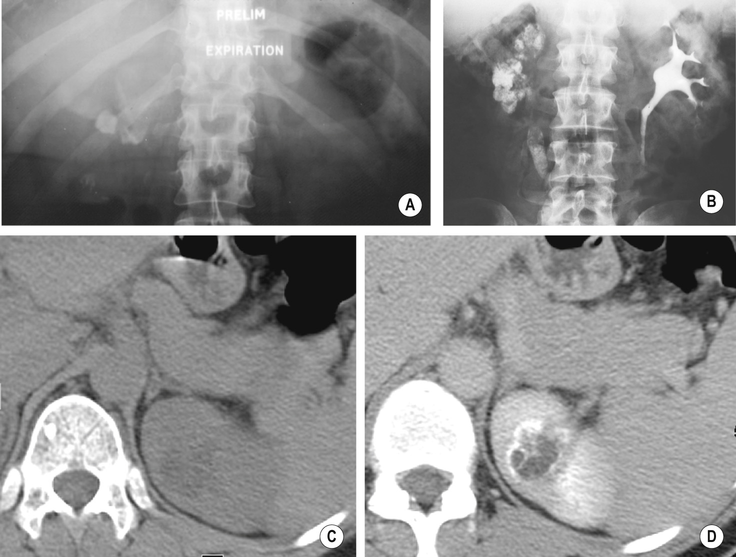 Urinary tract tuberculosis. The plain film (A) demonstrates calcification within distended upper pole calyces. Classical end-stage upper tract tuberculosis is the autonephrectomy (B) in which the chronically obstructed pelvicalyceal system is filled with calcifying caseous pus associated with complete renal parenchymal destruction. In this case there is also similar calcifying pus in an obstructed dilated upper ureter. † (C) Unenhanced axial CT demonstrates hypodense area at the upper pole of the left kidney medially with marginal enhancement at contrast-enhanced axial CT (D). **