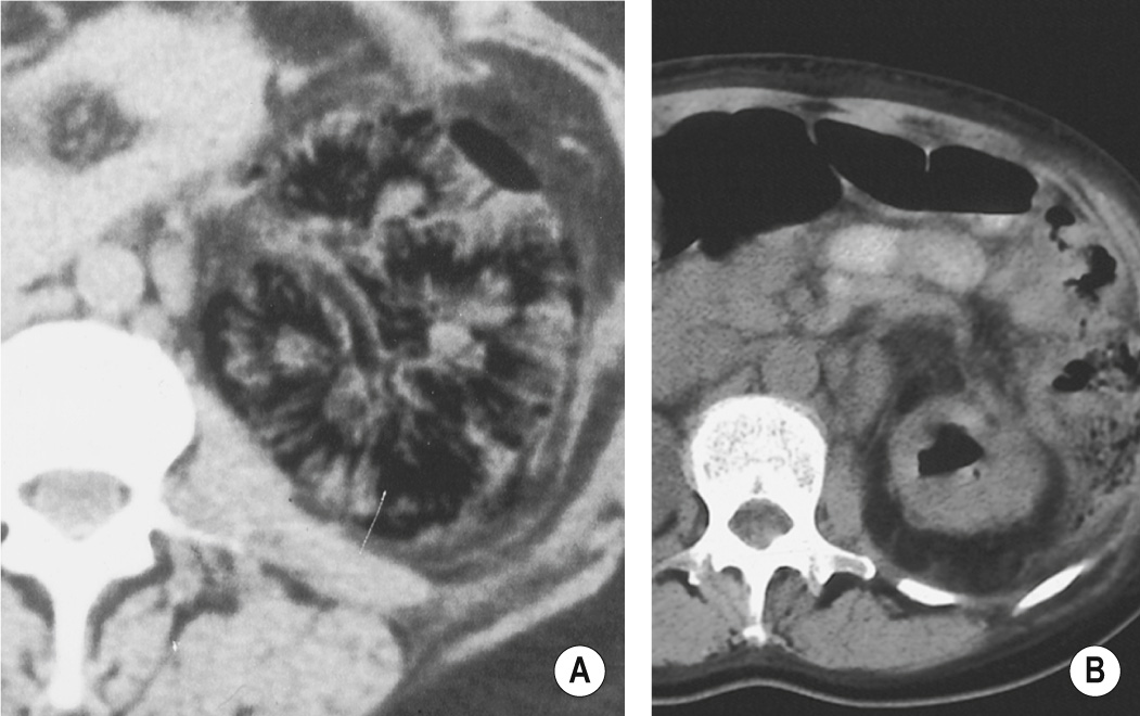 (A) CT demonstrating diffuse emphysematous pyelonephritis. (B) Emphysematous pyelitis. CT demonstrating gas within the collecting system. †