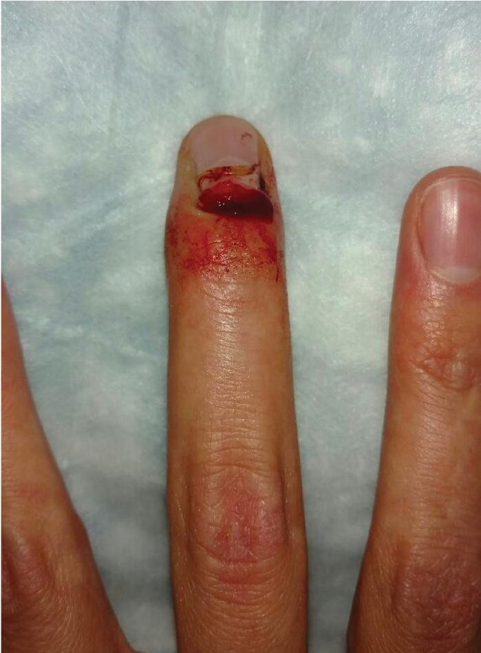 FIGURE 8.1, Laceration over the eponychial fold reflects the possibility of associated nail bed injury.