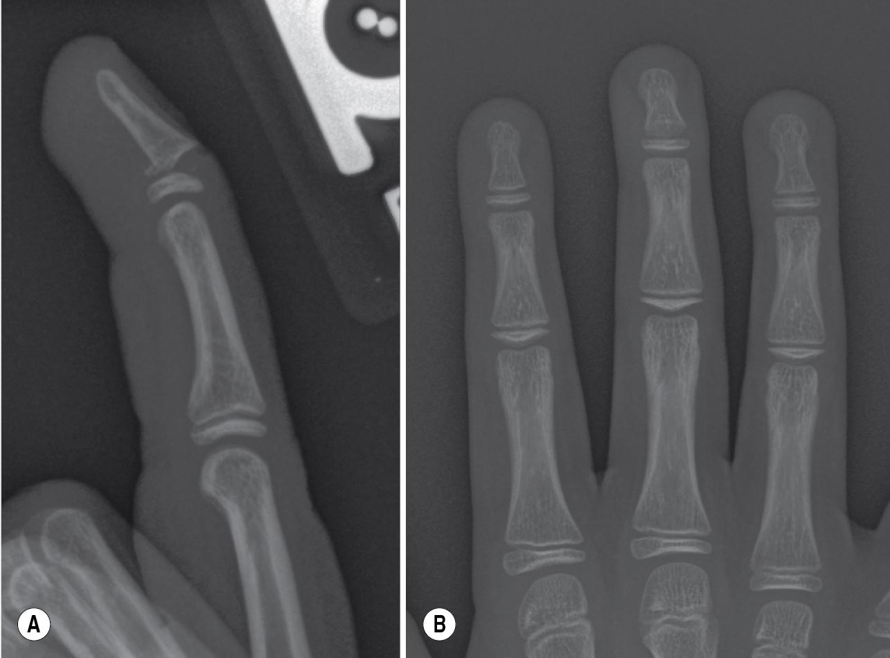 FIGURE 8.3, (AB) Displaced distal phalangeal physeal fractures are easier to recognize on lateral views compared with posteroanterior (PA) views.