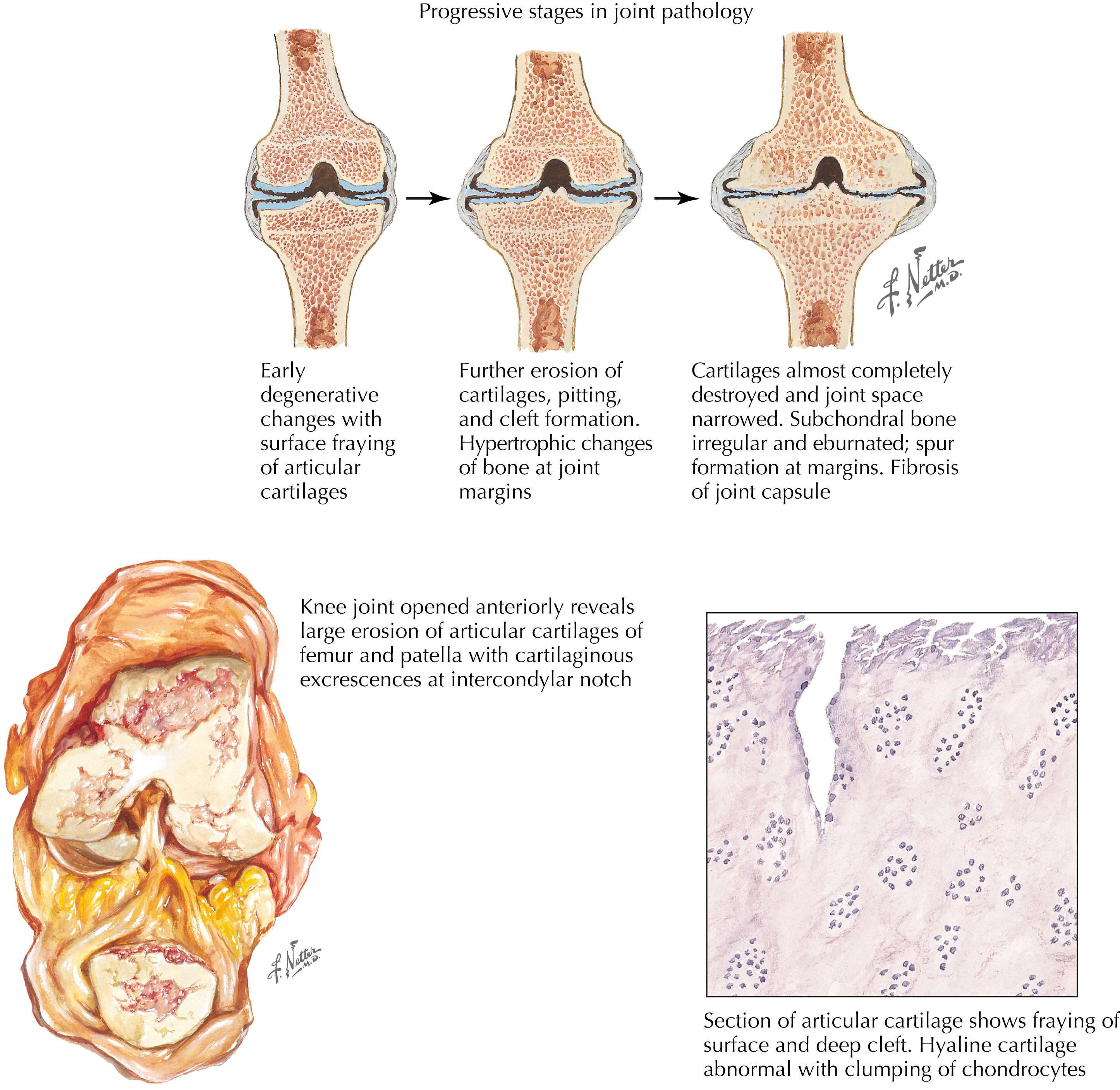 Figure 7-13, Osteoarthritis of the knee.