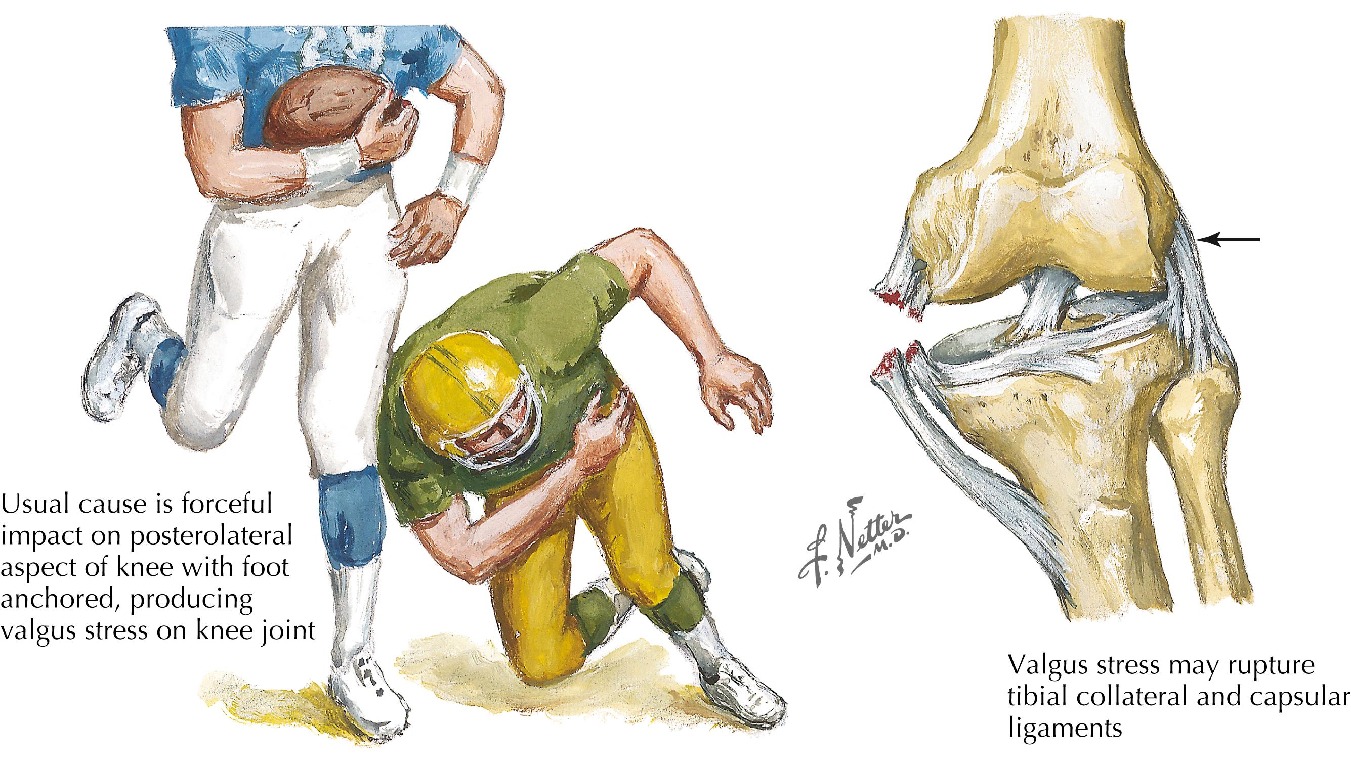 Figure 7-14, Medial collateral ligament rupture.