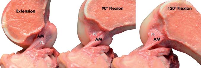 Fig. 89.11, Right knee dissection demonstrating the changes in shape and position of the AM (anteromedial bundle) and the PL (posterolateral bundle) of the anterior cruciate ligament. With the knee in extension, the femoral insertion site of the PL bundle is posterior and inferior to the AM bundle on the lateral femoral condyle.