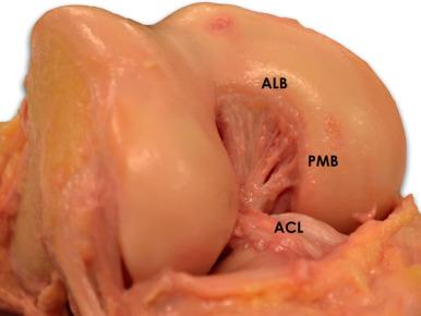 Fig. 89.12, Right knee dissection showing the ALB (anterolateral bundle) and PMB (posteromedial bundle) of the posterior cruciate ligament.