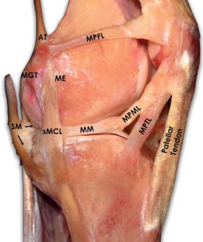 Fig. 89.13, Medial view of a left knee at 90 degrees of flexion demonstrating the attachment sites and orientations of the medial structures of the knee.