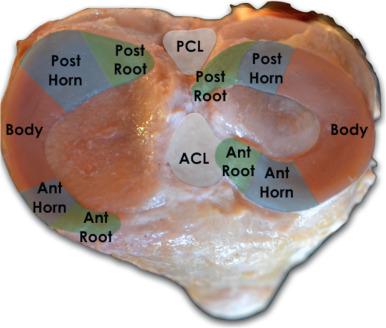Fig. 89.9, Anatomic dissection demonstrating the shape of both menisci (medial and lateral).