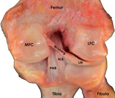 Fig. 89.10, Finely dissected posterior aspect of a right knee.