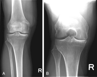 Fig. 104.1, (A) A conventional standing anteroposterior radiograph of the right knee with no visible joint space narrowing. (B) A “Rosenberg view” of the same knee shows evidence of joint space narrowing and osteoarthritis.
