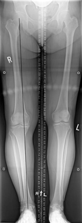 Fig. 104.2, This standing hip-to-ankle radiographic view is critical in decision-making and surgical planning. A line from the center of the hip to the center of the ankle defines the mechanical axis in the coronal plane. In a neutrally aligned limb, this line passes through the center of the knee. Any deviation from this point is considered malalignment. Here the line falls toward the medial side of the knee, indicating varus alignment of the limb.