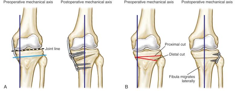 Fig. 104.4, Basic principles of opening wedge (A) and closing wedge (B) high tibial osteotomies.