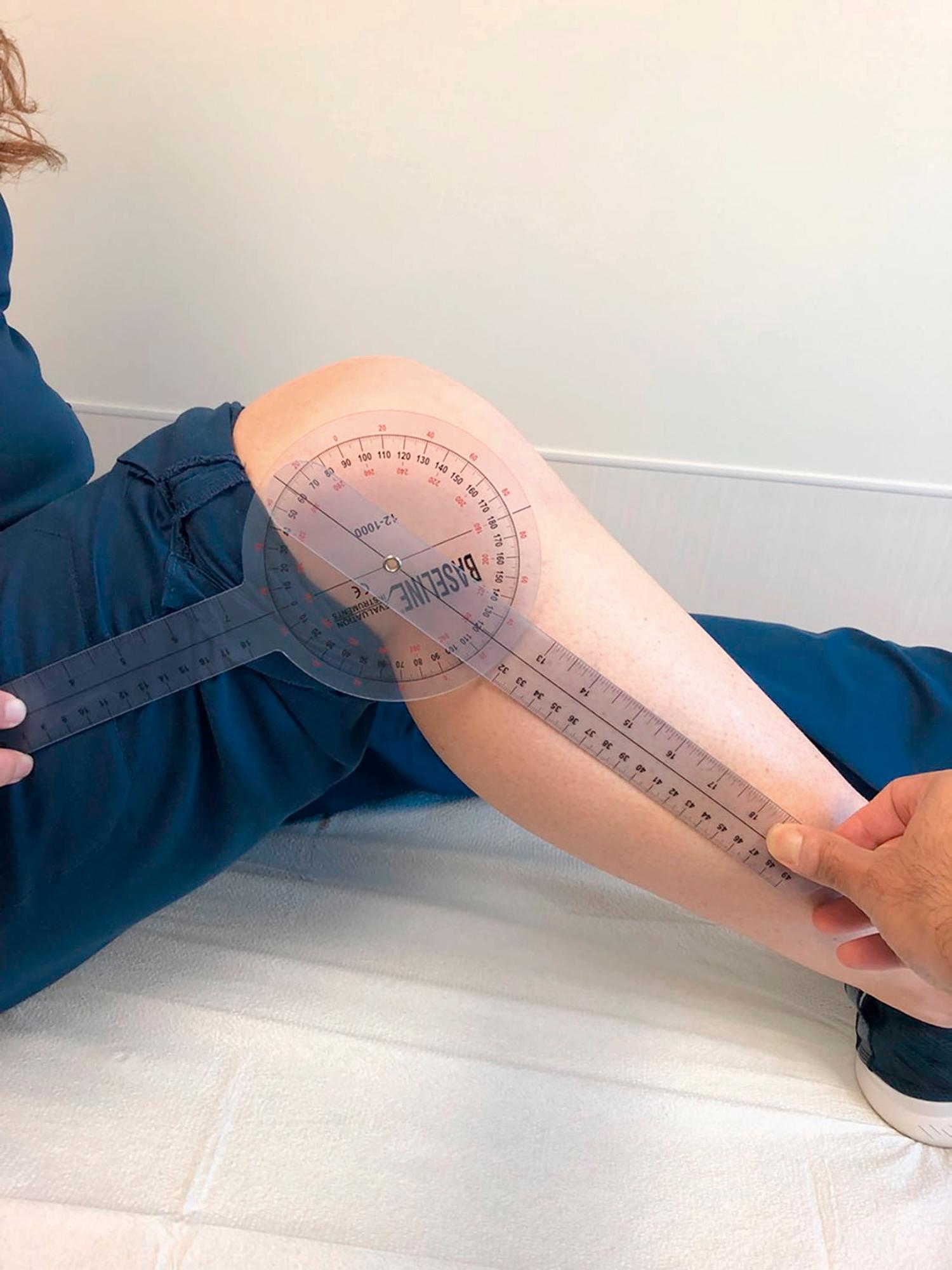 Fig. 35.1, Full range of motion of the knee can be measured with a goniometer and typically ranges from 5 degrees of hyperextension to full passive flexion averaging 143 degrees in women and 140 degrees in men. 8 , 9