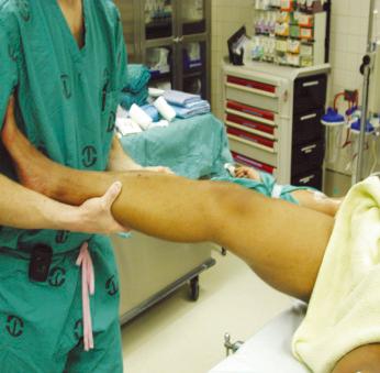 Fig. 90.20, Pivot shift testing, shown preoperatively after administration of an anesthetic. In this examination maneuver, the examiner applies an external rotation and valgus stress to the fully extended knee and then slowly flexes, feeling for a reduction “clunk” at 20 to 30 degrees of flexion.