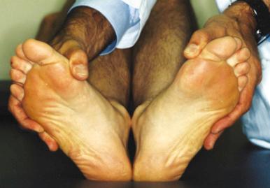 Fig. 90.25, Dial testing performed with the patient supine at 30 degrees of flexion. The side-to-side difference in the angle between the foot and the axis of the tibia denotes degree of laxity of the posterolateral corner.