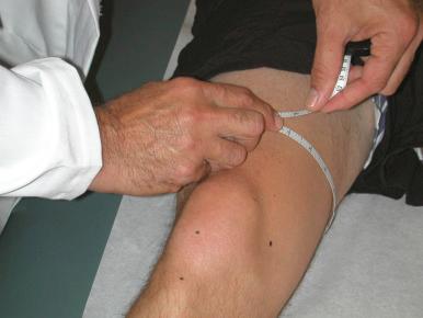 Fig. 90.3, Thigh circumference, which the examiner should always measure at the same distance proximal to the superior patellar pole, is a sensitive measure of quadriceps atrophy.