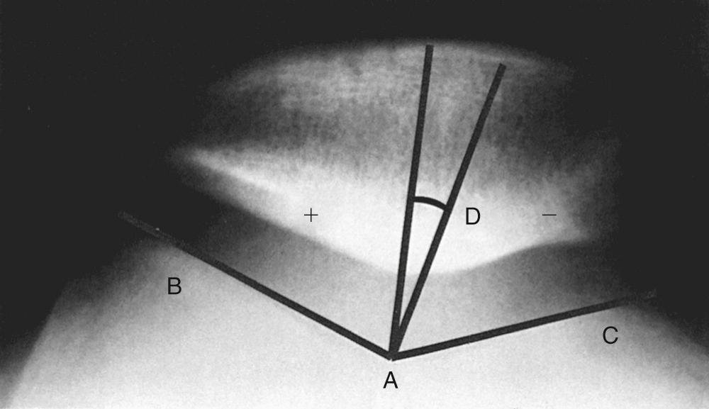 FIG 5.11, Merchant View; Measurement of the Sulcus and Congruence Angles