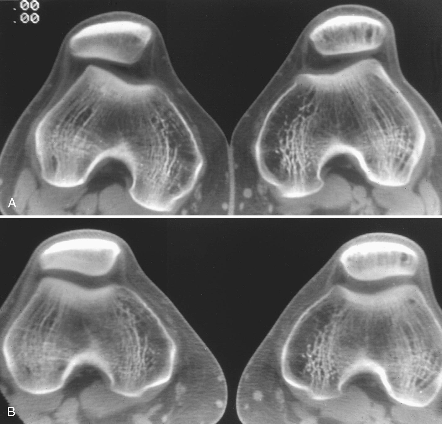 FIG 5.12, CT Assessment of Patellar Tracking