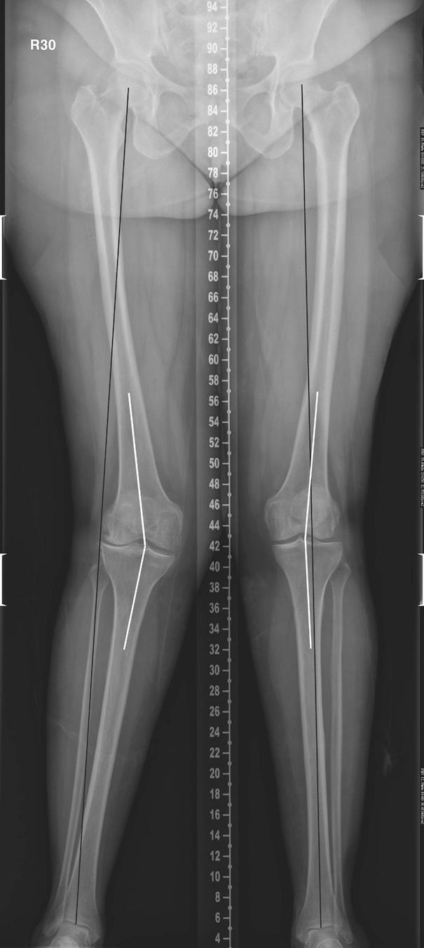 FIG 5.13, Long-Standing Views of Bilateral Lower Extremities