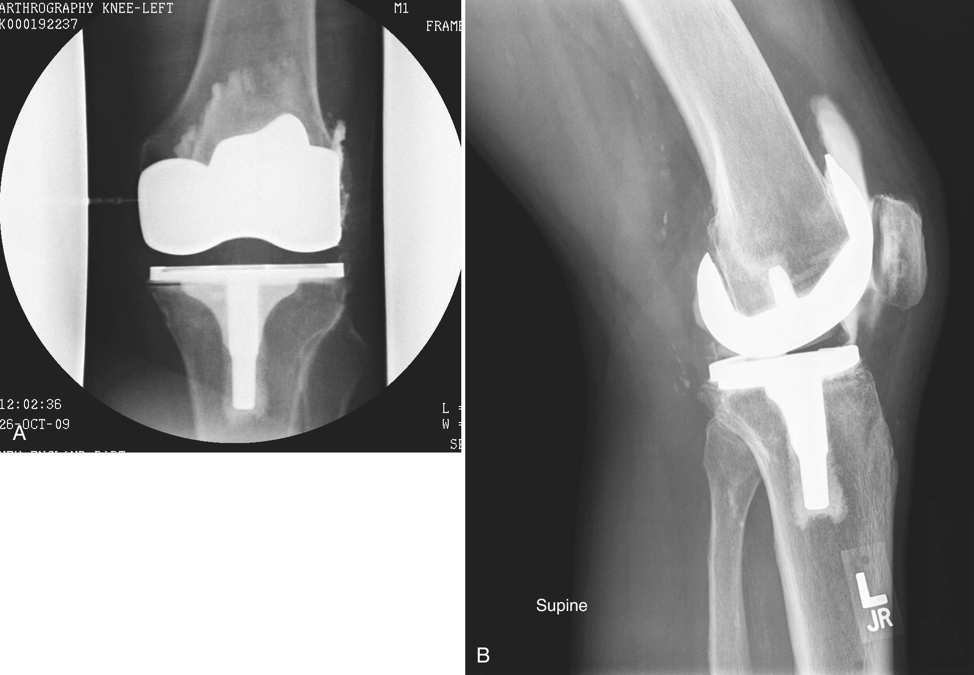 FIG 5.14, Normal Knee Arthrogram in a Patient With a Total Knee Arthroplasty