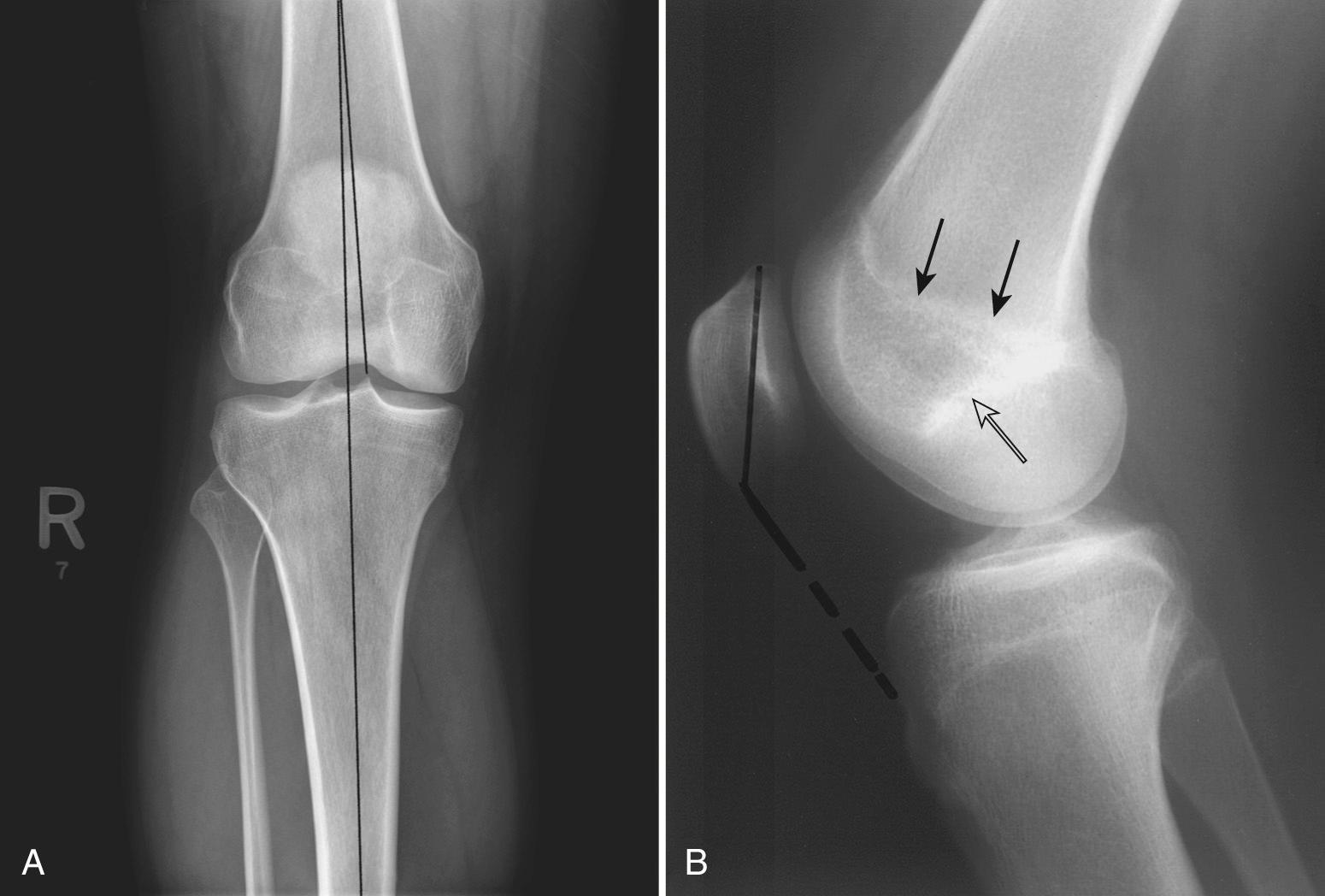 FIG 5.2, (A) Normal anteroposterior view of the right knee. Femoral-tibial alignment is in 6 degrees of valgus angulation. The lateral compartment is normally slightly wider than the medial compartment. (B) Lateral view of the knee. Blumensaat line (open arrow) represents the roof of the intercondylar notch. The physeal scar is indicated by the solid arrows. The patella is commonly located between these two lines, with the lower pole approximately at the level of Blumensaat line. The Insall-Salvati ratio is a more accurate method of assessing patellar height: the length of the patellar tendon (dotted line) divided by the greatest diagonal length of the patella (solid line) should be approximately 1 (0.8 to 1.2).