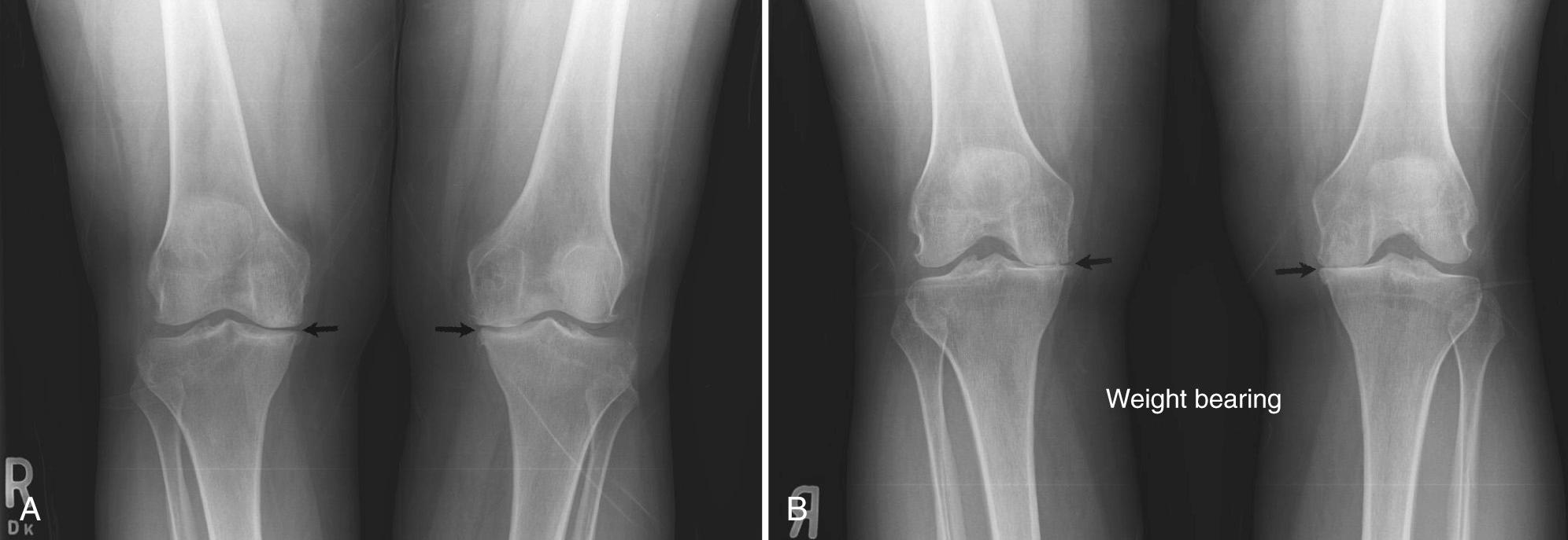 FIG 5.6, The Flexed Weight-Bearing posteroanterior (PA) View