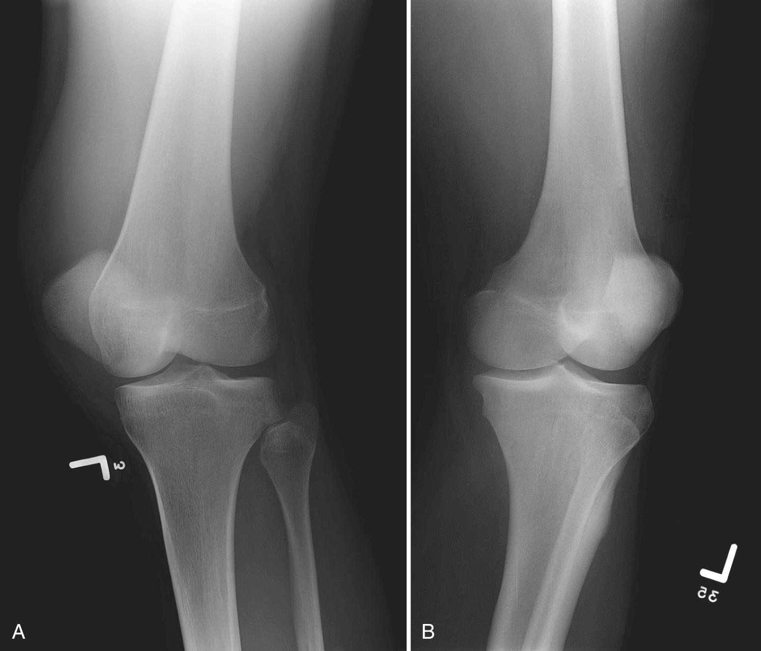 FIG 5.7, Internal (A) and external (B) rotational views of the knee in different patients. In external rotation the tibia and fibula are superimposed on each other; with internal rotation there should be less superimposition. A suprapatellar joint effusion is seen on the internally rotated view.