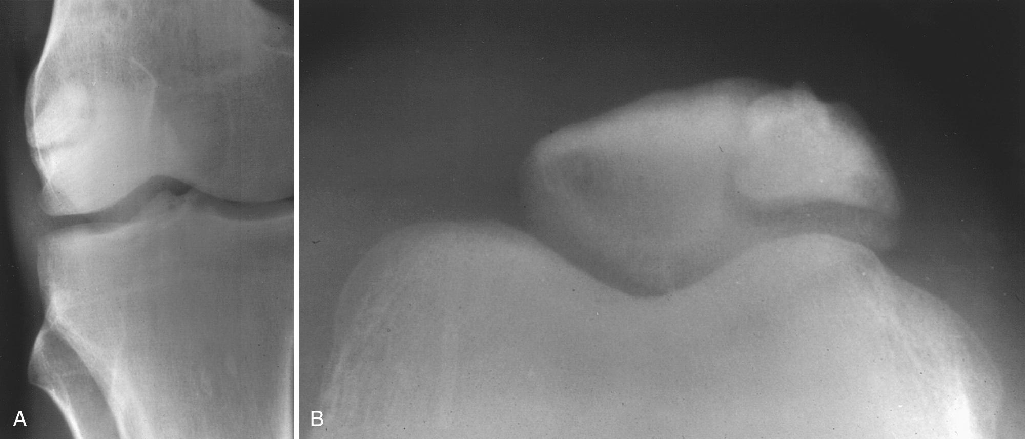 FIG 5.9, Bipartite Patella