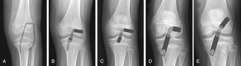 Fig. 137.1, Radiographs revealing representative images of patients with bone ages of 6 to 14 years. (A) Bone age of 6 years: Micheli-Kocher intra-articular extra-articular procedure. (B) Bone age of 8 years: Anderson all-epiphyseal procedure, which has been modified. (C) Bone age of 10 years: Ganley-Lawrence all-epiphyseal docking procedure. (D) Bone age of 12 years: Hybrid all-epiphyseal femoral transphyseal tibial procedure. (E) Bone age of 14 years: Transphyseal femoral and tibial reconstruction with soft tissue only at the level of the physis.