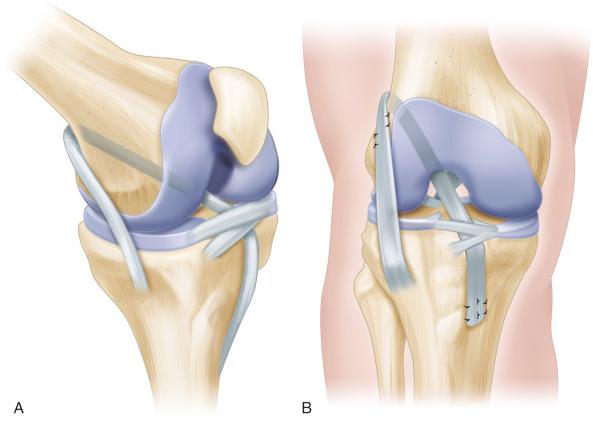 Fig. 137.3, (A and B) The iliotibial band graft is passed over the top of the lateral femoral condyle, through the knee, under the intermeniscal ligament, and into the groove in the proximal tibia. The graft is sutured to the lateral femoral condyle with the knee in 90 degrees of flexion and 15 degrees of external rotation. It is then sutured to the periosteum of the proximal tibia with the knee in 20 degrees of flexion.