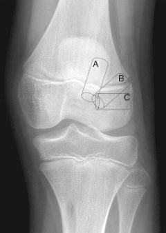 Fig. 137.4, Amount and location of femoral physis affected using different operative techniques. (A) The location of a vertically orientated tunnel, which affects less of the femoral physis but is typically outside the native anterior cruciate ligament (ACL) footprint. (B) The location of a classic anatomic accessory medial portal, or outside-in technique, that places the tunnel anatomically in the ACL footprint but affects a large portion of the distal femoral physis. (C) The location of a femoral tunnel, which is in the anatomic center of the ACL footprint within the epiphysis in a trajectory. It avoids the femoral physis.