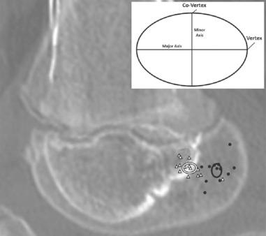 Fig. 137.5, The 95% confidence intervals and distribution of individual lateral collateral ligament (white triangles) and anterior cruciate ligament (black circles) origins. The inset shows the elliptical footprint orientation and terminology reference.