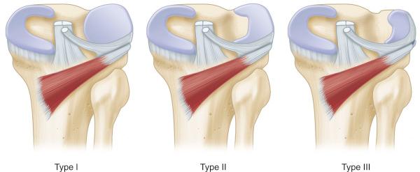 Fig. 137.7, Watanabe classification of discoid lateral meniscus. Type I is a complete variant, type II is a partial variant, and type III is a Wrisberg variant.