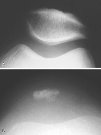 Fig. 137.8, Sunrise view of the patellofemoral joint in an adult man (A) and an 8-year-old boy (B).