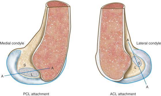 FIG 4-11, The division of the femoral ligament attachment into fibers that shorten (S) and lengthen (L) with knee flexion (reverse with knee extension). The line A to A, dividing the regions, has a different orientation for the two cruciate ligaments. Small errors in placement along the direction of the line have only small effects on length patterns. The approximate location of the line in reference to the posterior cruciate ligament (PCL) and anterior cruciate ligament (ACL) footprint is shown, with the qualification that the line changes its orientation with knee flexion. In contrast, placement errors perpendicular to the line cause large changes in length patterns.