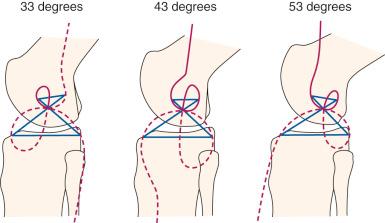 FIG 4-16, Burmester curves computed for flexion angles of 33, 43, and 53 degrees. The curves for 43 degrees of flexion are nearly identical to the curves published by Menschik 54 55 and Mueller. 59 Note that most of the tibial cubic for 33 degrees and 53 degrees of flexion is not on the tibia and thus they are not possible ligament attachments.