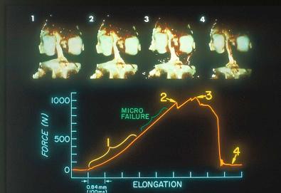 FIG 4-17, Oscillograph record of force versus time for a tension test to failure of a rhesus femur-ACL-tibia preparation. A constant distraction rate was used so that the time axis was proportional to specimen elongation. The images, obtained from high-speed videos taken during the test, show the preparation at four stages of the test.