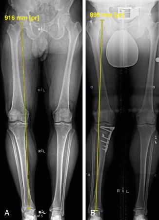 • Fig. 23.1, Coronal plane overcorrection to valgus following medial opening wedge high tibial osteotomy and tibial tubercle osteotomy for varus osteoarthritis. (A) Preoperative and (B) 4 months postoperative.