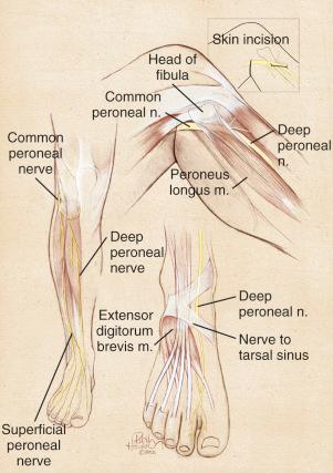 FIG 39-3, Common peroneal nerve enters the leg at the fibular head and divides into the deep and superficial peroneal nerves. Inset , The typical incision for the decompression of the common peroneal nerve. The superficial peroneal nerve entrapment site as it exits from the deep fascia is noted laterally, and the deep peroneal nerve entrapment site is illustrated beneath the extensor hallucis brevis tendon.