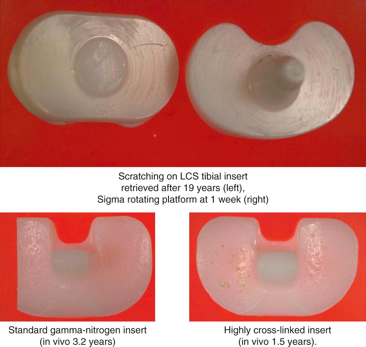 FIG 24.1, Scratching and pitting are common on retrieved knee bearings and often represent visible damage, but not loss of material in the form of debris. Improvements to polyethylene, such as cross-linking, do not prevent scratching or pitting caused by third-body debris. (A) Scratching on an LCS tibial insert retrieved at 19 years (left) and a Sigma RP retrieved at 1 week (right). (B) Gamma–nitrogen barrier packaged insert at 3.2 years. (C) HXL polyethylene insert at 1.5 years. LCS , Low-contact stress.