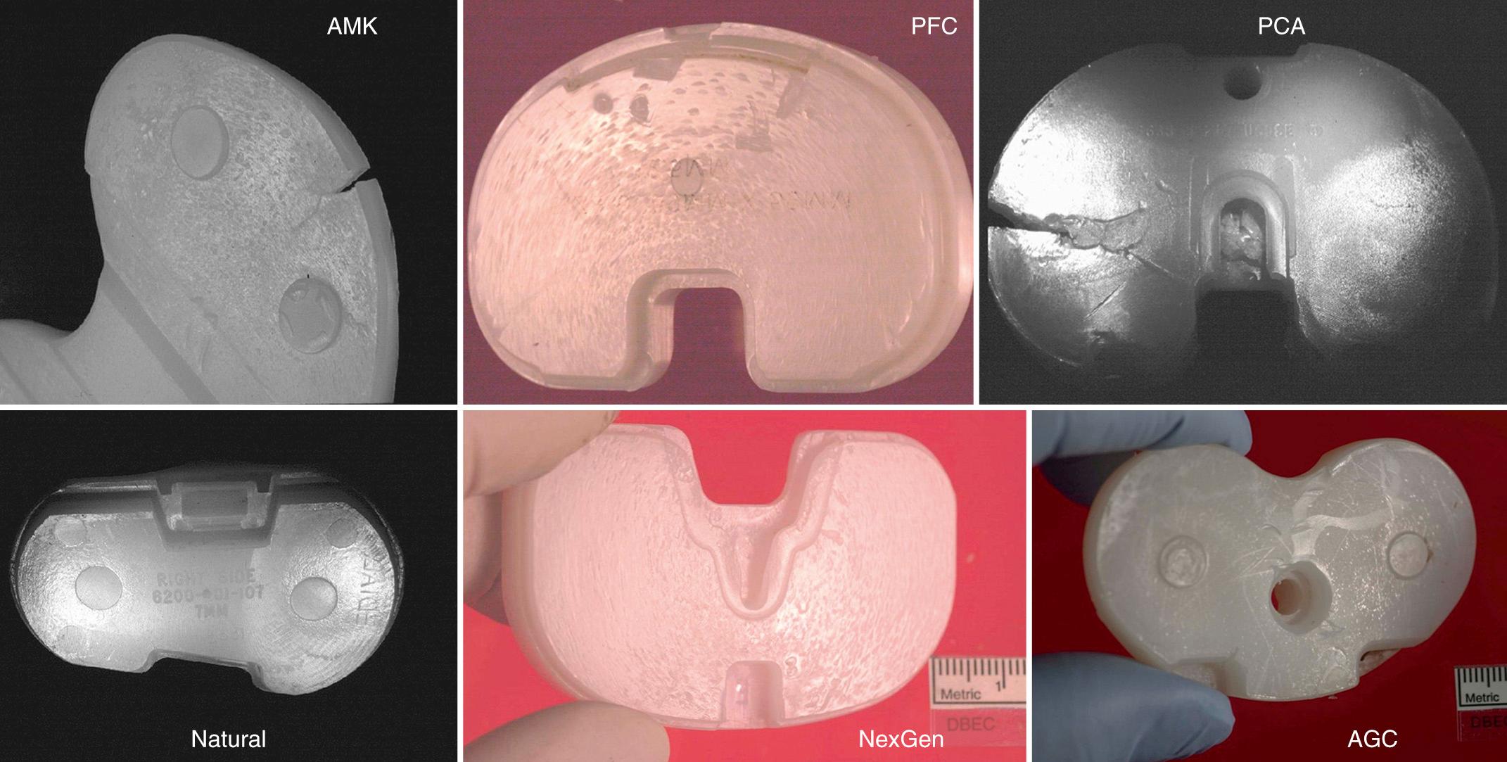 FIG 24.5, Evidence of backside motion and wear is common on retrievals of many different modular fixed-bearing knee designs. The insert-tray relative motion indicated by the patterns and backside wear features is most often rotational motion. Torque from the femoral component is not effectively resisted by arc-shaped peripheral capture rims, or by centrally located locking mechanisms.