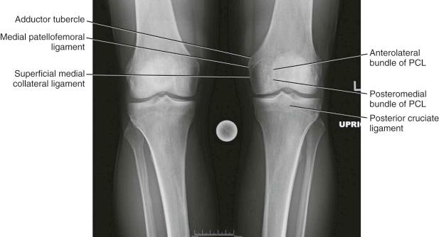 FIGURE 7-12, Radiologic landmarks of the knee. PCL, Posterior cruciate ligament.